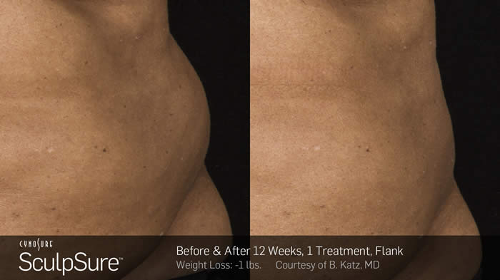 SculpSure - Mid-Atlantic Skin Surgery Institute