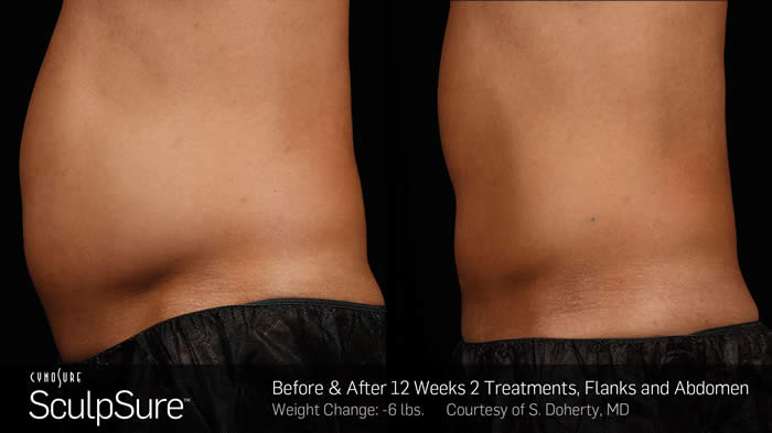 SculpSure - Mid-Atlantic Skin Surgery Institute