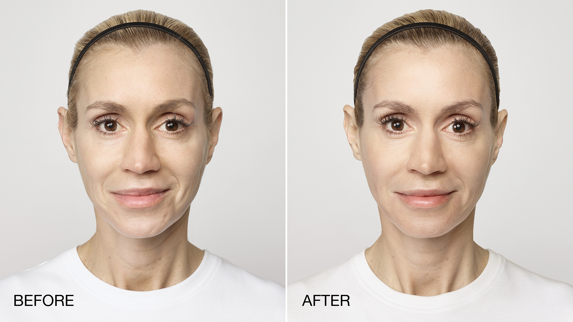 Restylane - Mid-Atlantic Skin Surgery Institute