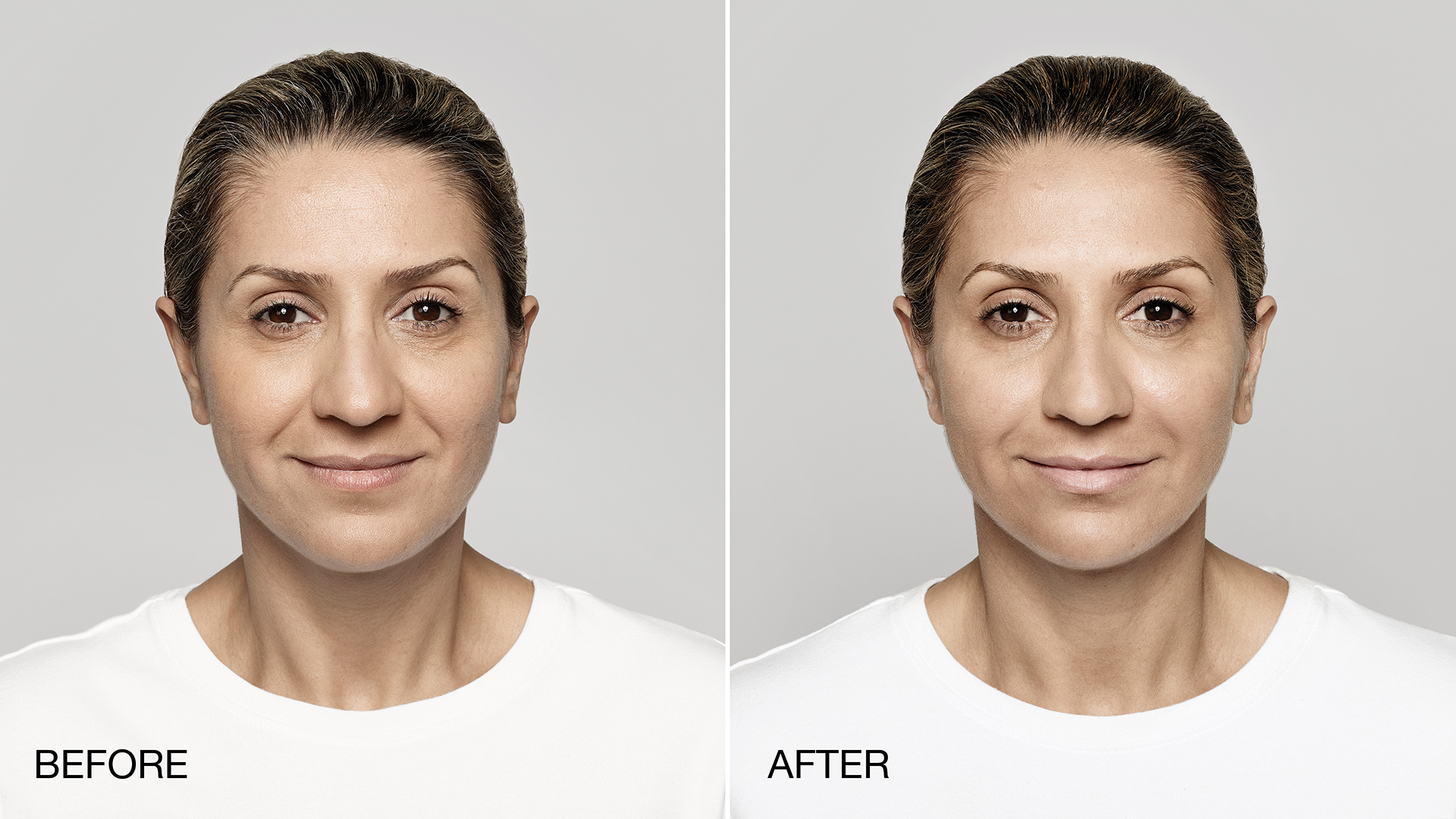 Restylane Mid Atlantic Skin Surgery Institute