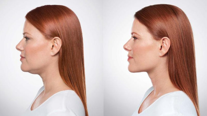 Kybella Specials