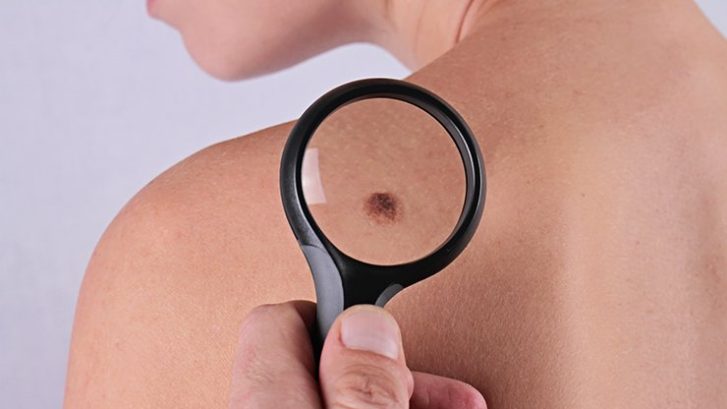 Free Skin Cancer Screening Maryland