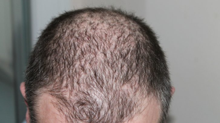 hair growth maryland