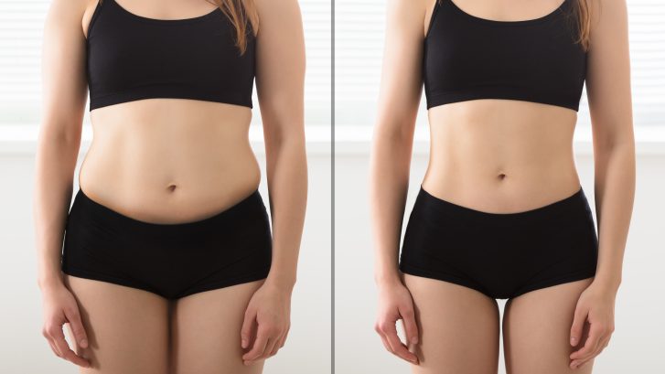 Smart Lipo - Before and After