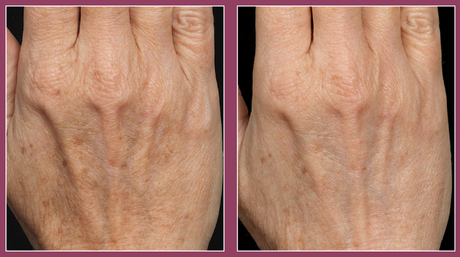 Fraxel Maryland Fraxel Laser Resurfacing Waldorf Mid Atlantic Skin