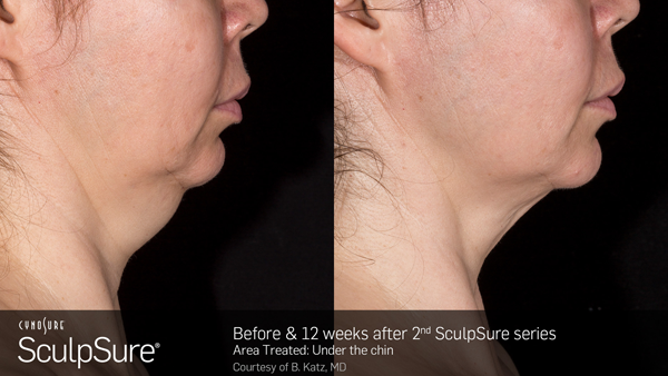 sculpsure maryland