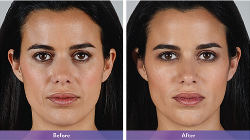 Vollure Juvederm Maryland