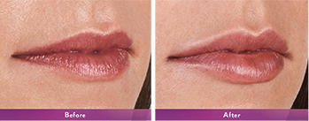 Volbella Juvederm Maryland