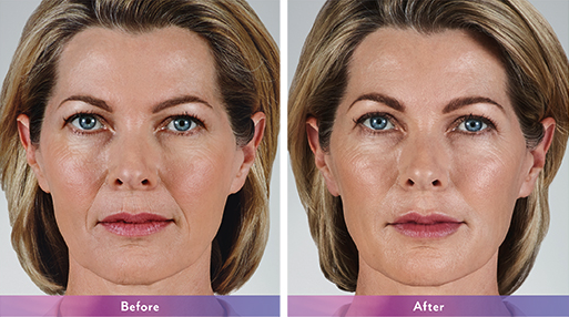 Voluma XC Juvederm Maryland