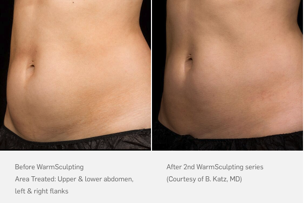 Liposuction Versus Non-Invasive Body Sculpting: What's the