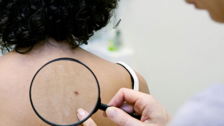 SRT and Mohs | Skin Cancer Treatment Maryland | Mid-Atlantic Skin