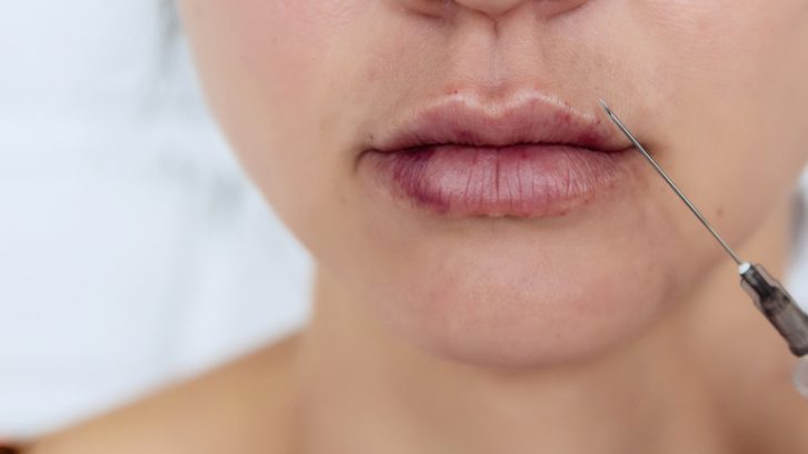 Lip Filler Swelling Stages: What Is Normal