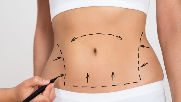 best liposuction results