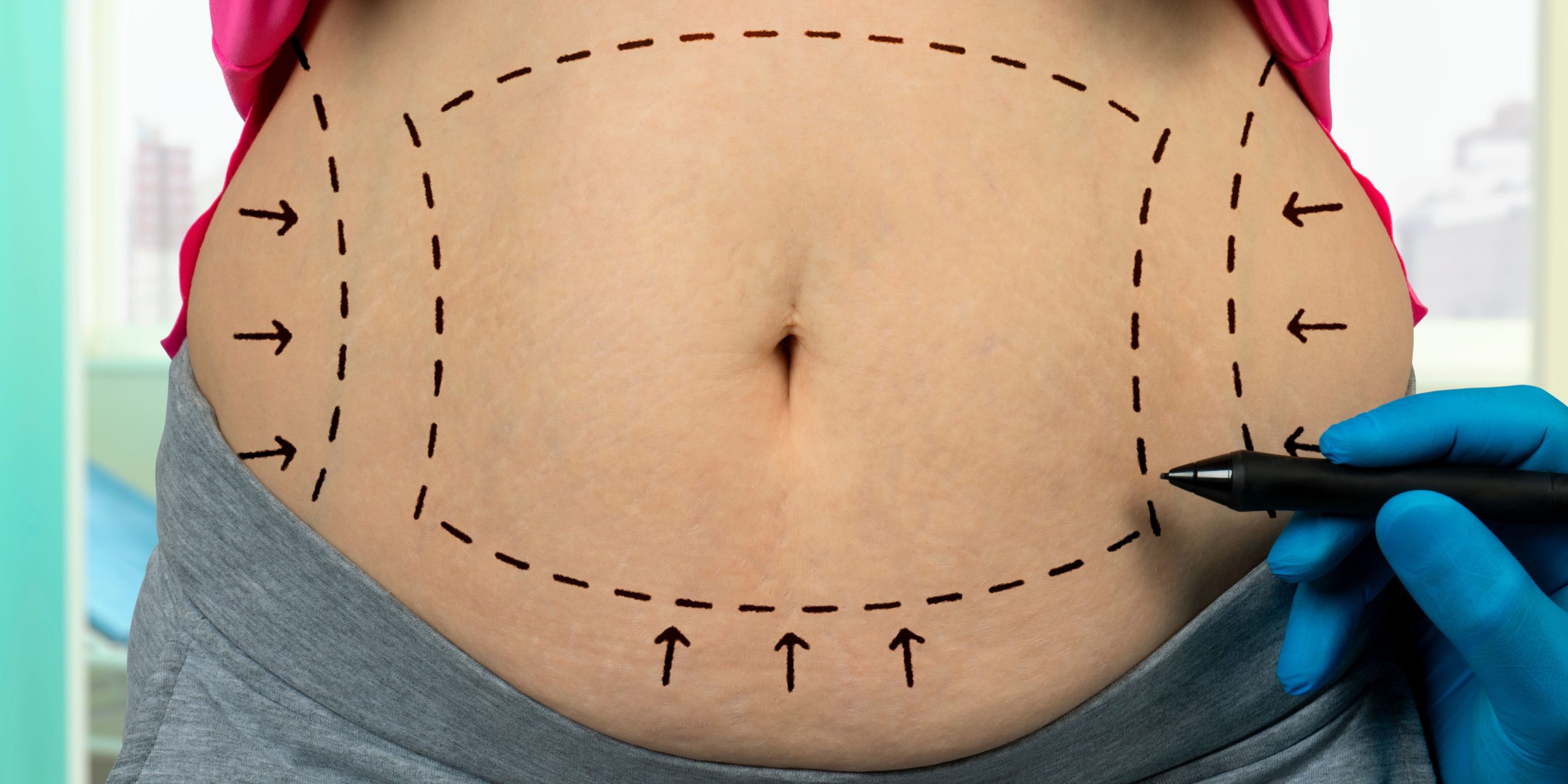 Liposuction: What to Expect During and After Recovery - Mid