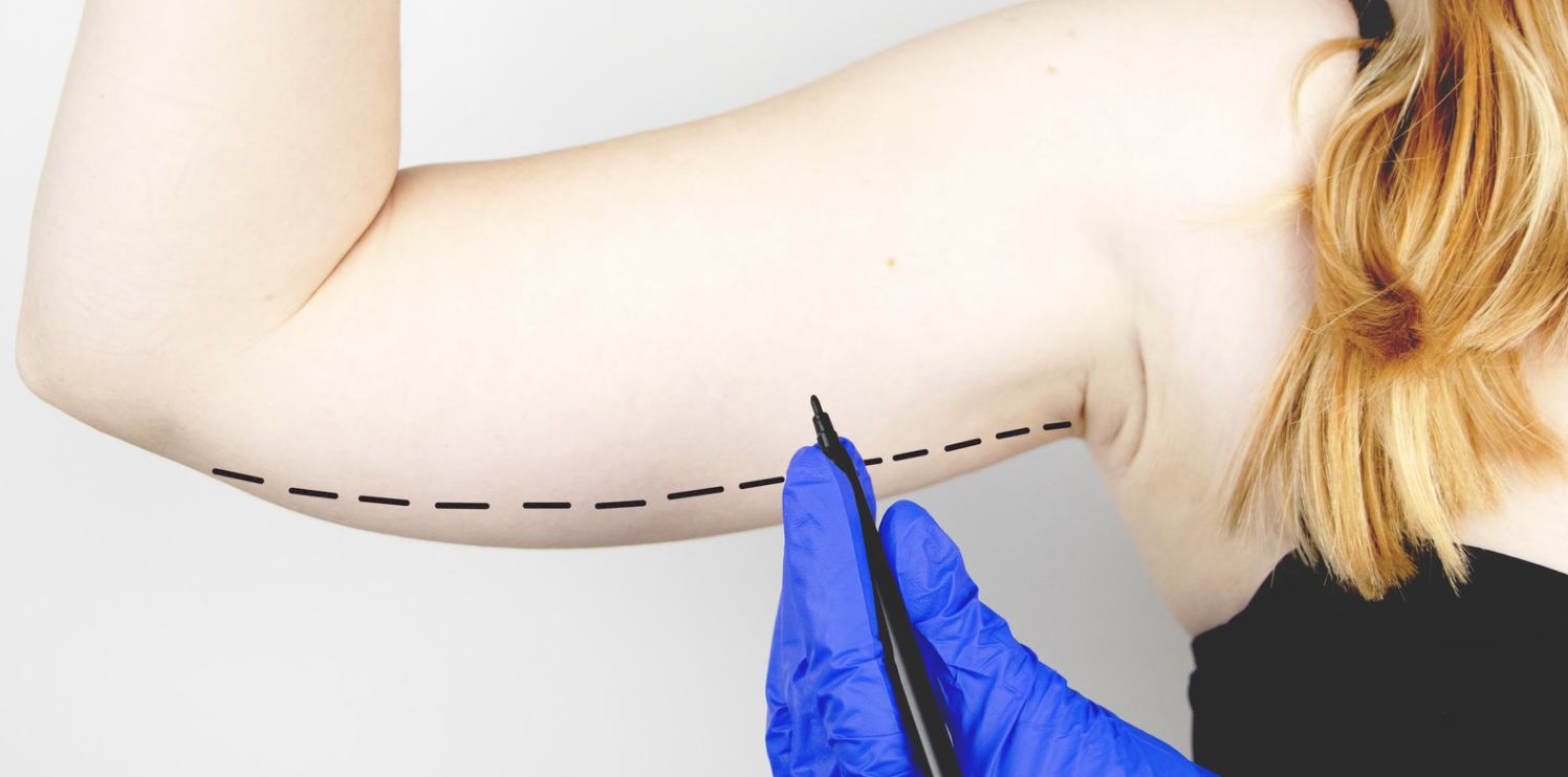 What Are the Different Types of Lipo in Frederick MD? - Hagerstown