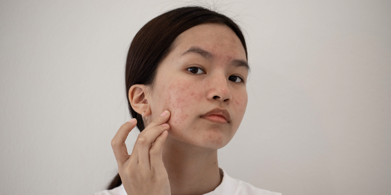 Choosing the Best Acne Doctor in California MD - Mid-Atlantic Skin ...