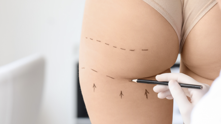 Liposuction Surgery Cost in maryland