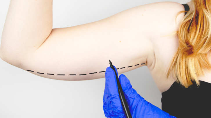 Liposuction Surgery Costs in Huntingtown