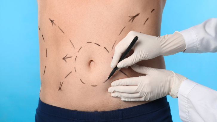 Exploring Liposuction Options in Waldorf, MD for Body Contouring