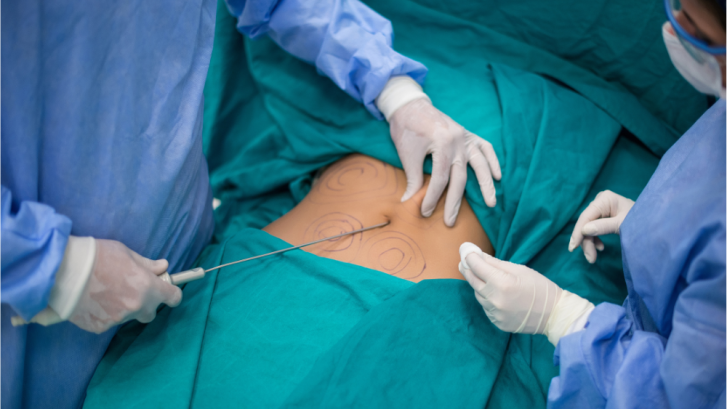 Top Liposuction Surgeons Near Upper Marlboro, MD