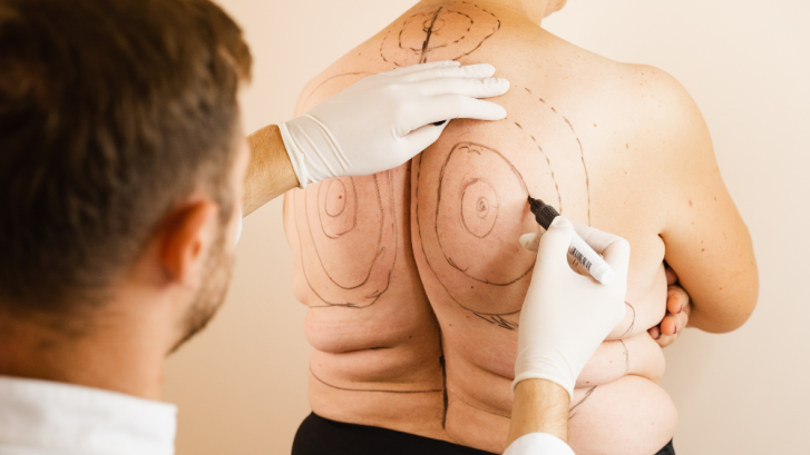 Is Liposuction Right for You in Accokeek, Maryland?