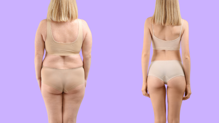 What to Expect Before and After Liposuction in Fort Washington, Maryland