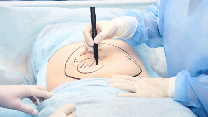 Explore Liposuction Options in Prince Frederick, MD