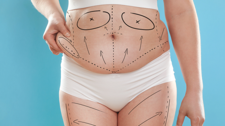 Liposuction Cost Guide in Charles County, Maryland