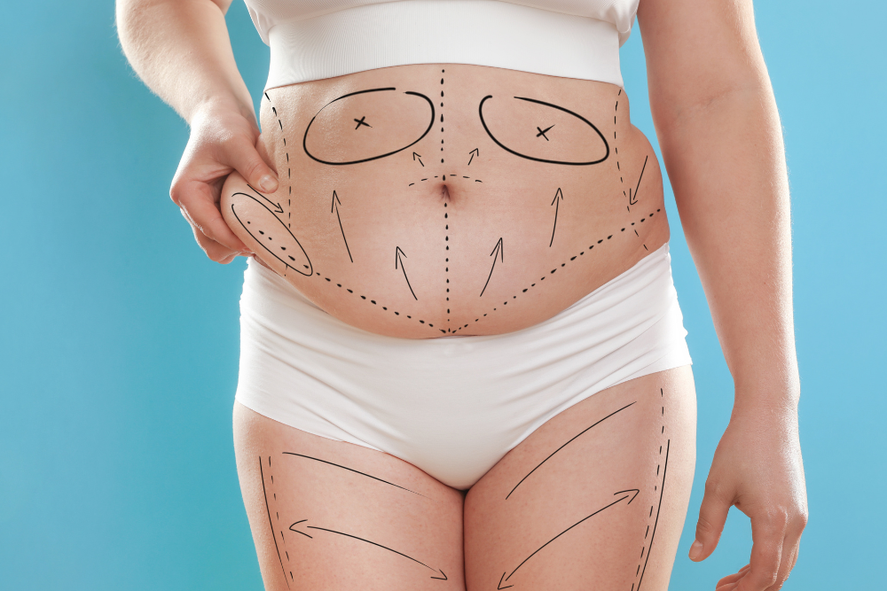 Liposuction Cost Guide in Charles County, Maryland&mdash;What to Expect from  Pricing and Fees - Mid-Atlantic Skin Surgery Institute