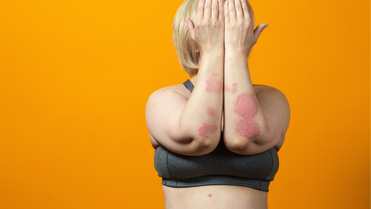 Best Psoriasis Specialist Near La Plata, Maryland