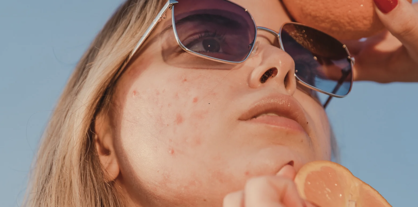 Leonardtown Acne Dermatologist Appointments - Mid-Atlantic Skin Surgery ...