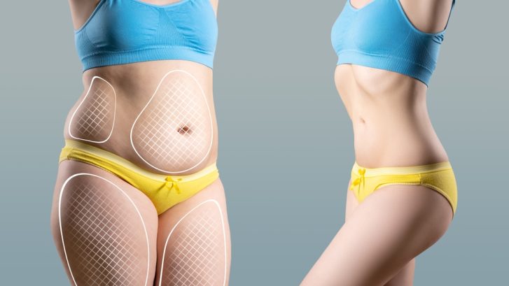 Liposuction Cost and Recovery in Waldorf, Maryland: What to Know