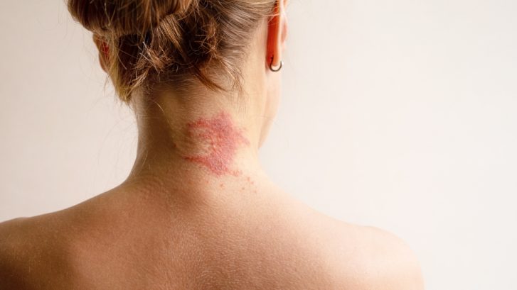 Eczema Flare Dermatology Appointment in Chesapeake Beach, Maryland: How to Prepare and What to Expect