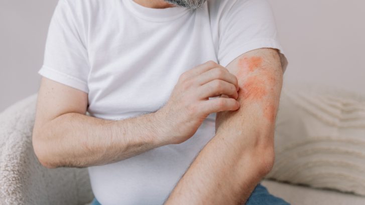 Eczema and Dermatitis Specialists in California, Maryland: Who Should Be Part of the Care Team?