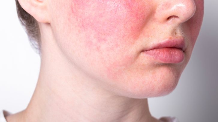 How to Find Rosacea Clinics in Hollywood, Maryland, Plus Treatment Tips