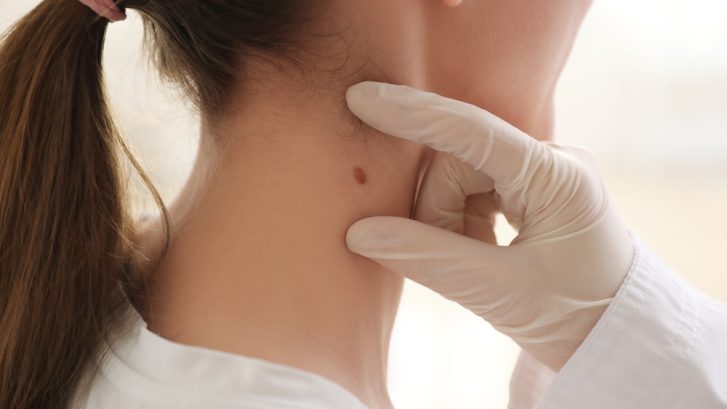 When to Get a Mole Removed in Great Mills, Maryland