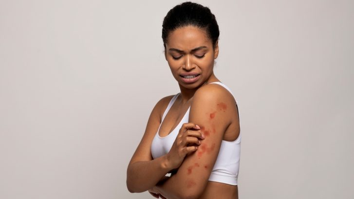 Skin Emergencies Chesapeake Beach MD