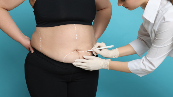 Average Cost of Liposuction for the Stomach and Flanks Near Clinton, MD
