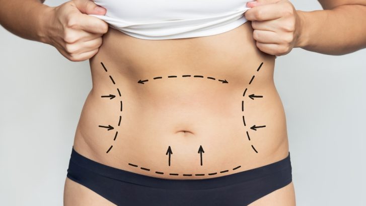What to Expect From Liposuction Near California, Maryland When You Choose Smartlipo