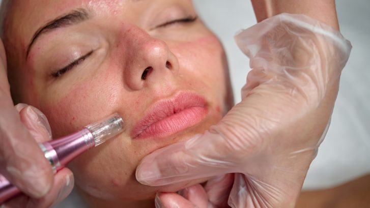 Microneedling Appointments in Lancaster, Pennsylvania: What to Expect