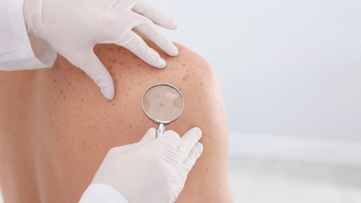 Skin Cancer Warning Signs in North Beach: When to Book a Dermatology Appointment