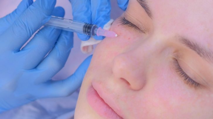 Tear Trough and Jawline Filler Near White Plains, MD: How to Book