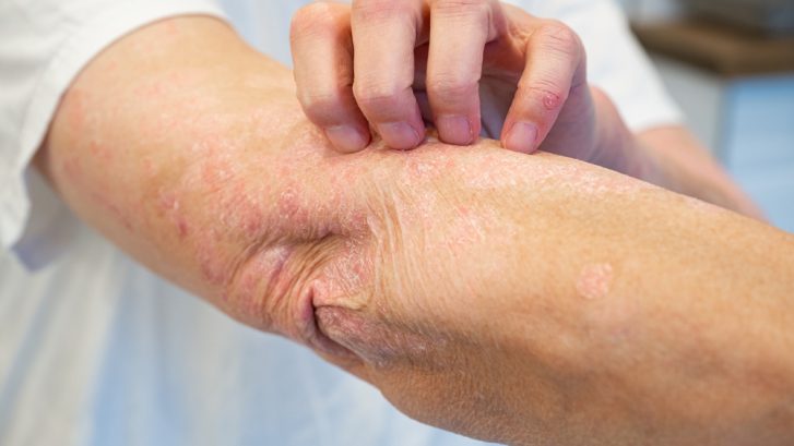 When Persistent Rashes in Huntingtown Should Prompt a Dermatology Visit