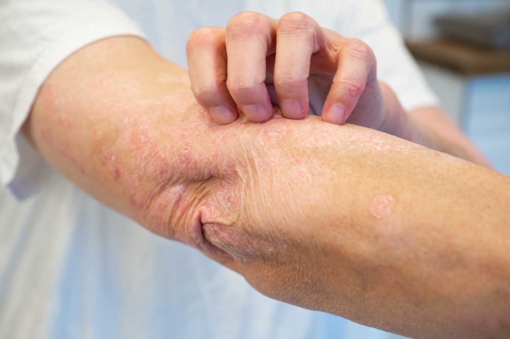Promptu Rashes When Persistent Rashes in Huntingtown Should Prompt a Dermatology Visit ...
