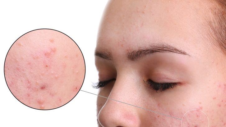 Chronic Acne in Lusby
