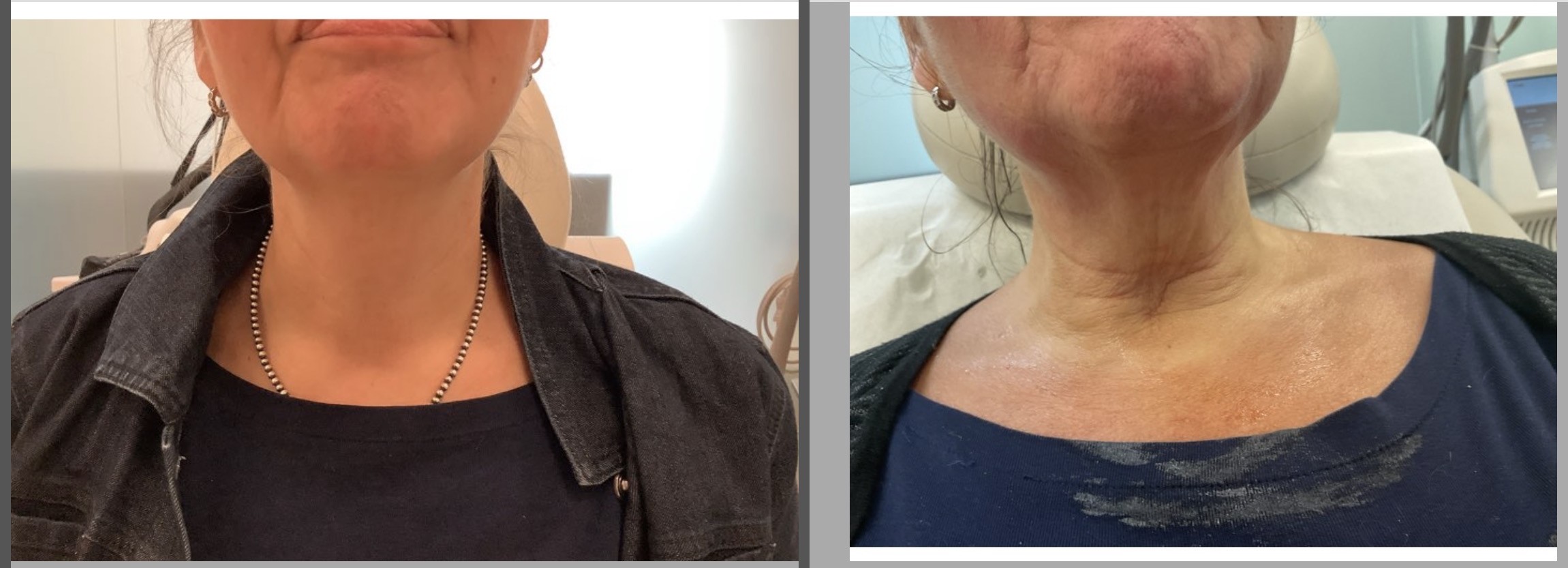 Fraxel neck lift before and after pictures