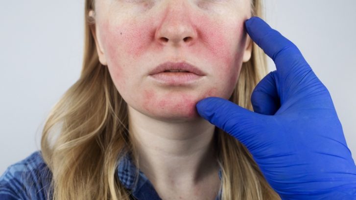 7 Signs to Make a Dermatology Appointment for Rosacea Treatment Near Lusby, MD