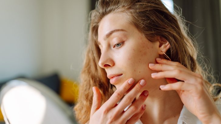 Book an Acne Dermatology Appointment for Teens and Adults Near Huntingtown, MD for These Symptoms
