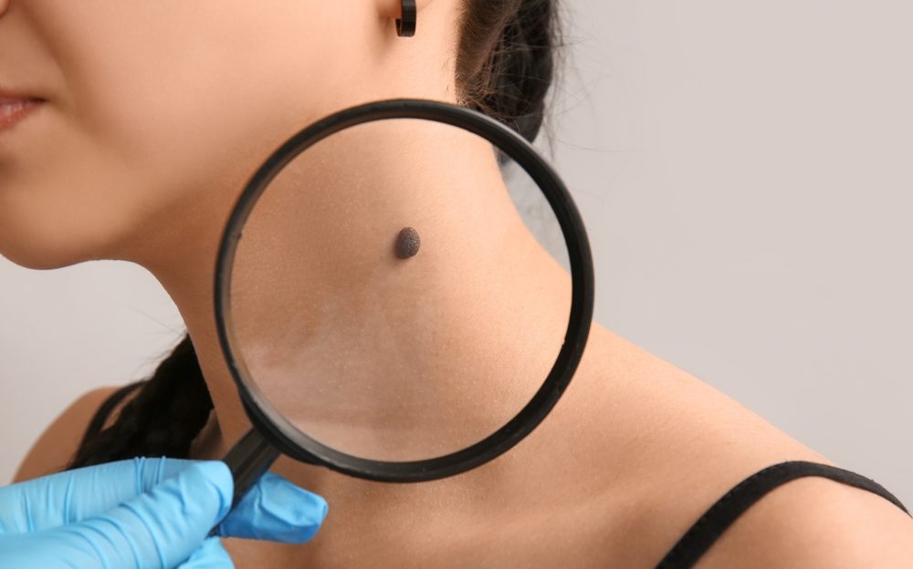 Don’t Delay Booking a Dermatologist Appointment for Changing Moles Near Huntingtown, Maryland