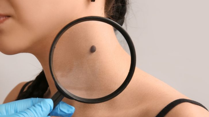 Don’t Delay Booking a Dermatologist Appointment for Changing Moles Near Huntingtown, Maryland
